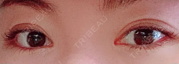 二重切開 / 目頭切開 / 上まぶたの脂肪取り 樹のひかり 形成外科・皮ふ科 DAY 238 メイン用