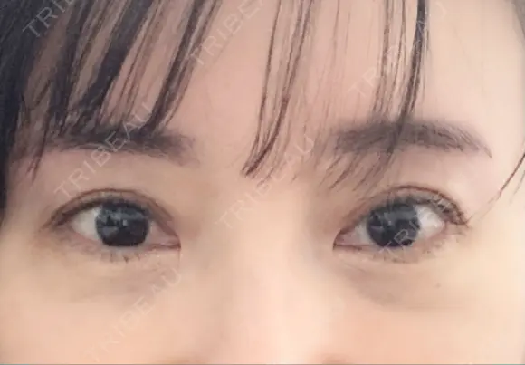 二重切開 / 眼瞼下垂（切開） 芦屋美容クリニック 芦屋院 DAY 90 メイン用