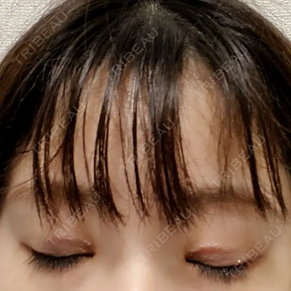 二重切開 こまちクリニック DAY 29 メイン用
