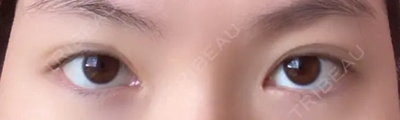 二重切開 / 目頭切開 / 上まぶたの脂肪取り 樹のひかり 形成外科・皮ふ科 DAY 271 メイン用