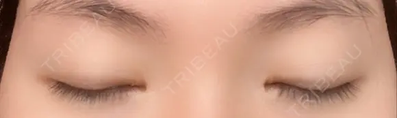 二重切開 / 目頭切開 / 上まぶたの脂肪取り 樹のひかり 形成外科・皮ふ科 DAY 271 メイン用