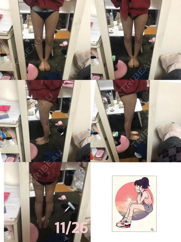 脂肪吸引（脚） / 脂肪吸引（お尻） ヨンセスリムライン DAY 46 メイン用