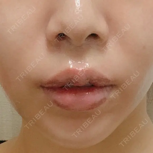 人中短縮 / その他（口元） eクリニック 金沢本院 DAY 7 メイン用