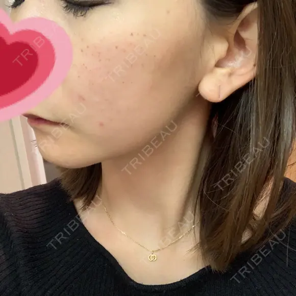 イオン導入 / フォトRF 湘南美容クリニック 表参道院 DAY 0 メイン用