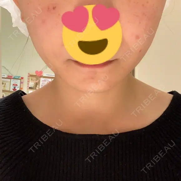 イオン導入 / フォトRF 湘南美容クリニック 表参道院 DAY 0 メイン用