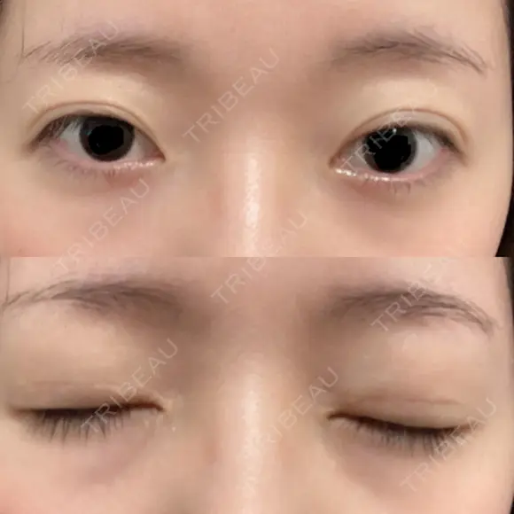 二重切開 松下皮フ形成外科 AFTER メイン用