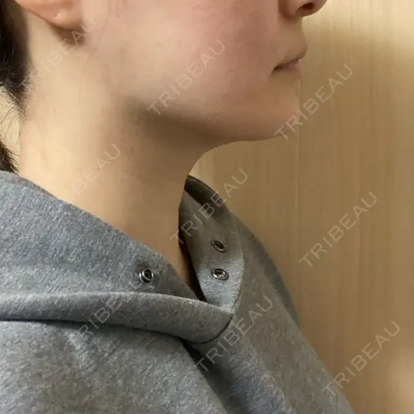 脂肪吸引（顔） THE CLINIC（ザ・クリニック） 福岡院 DAY 95 メイン用