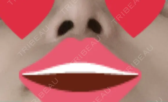 隆鼻術 / 鼻尖形成（切開） / 小鼻縮小（切開） / ほくろ・いぼ切除（肌） / 鼻翼挙上 東京形成美容外科 船橋院 AFTER メイン用