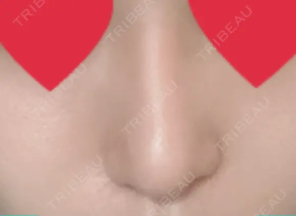 隆鼻術 / 鼻尖形成（切開） / 小鼻縮小（切開） / ほくろ・いぼ切除（肌） / 鼻翼挙上 東京形成美容外科 船橋院 DAY 273 メイン用