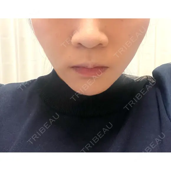バッカルファット除去 / 脂肪吸引（顔） EMMA CLINIC（エマクリニック） DAY 92 メイン用