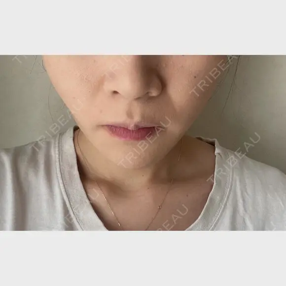 バッカルファット除去 / 脂肪吸引（顔） EMMA CLINIC（エマクリニック） AFTER メイン用