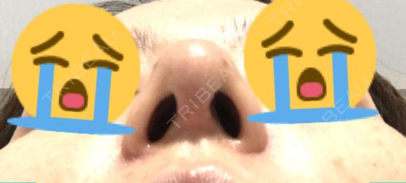 鼻中隔延長（切開） / 軟骨移植 / ワシ鼻修正・ハンプ切除 / ヒアルロン酸注入（鼻） プリモ麻布十番クリニック DAY 16 メイン用