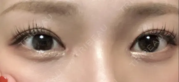 目頭切開 聖心美容クリニック 札幌院 DAY 23 メイン用