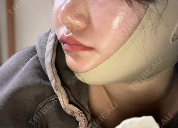 鼻尖形成（切開） / 軟骨移植 あつぎ美容クリニック DAY 70 メイン用