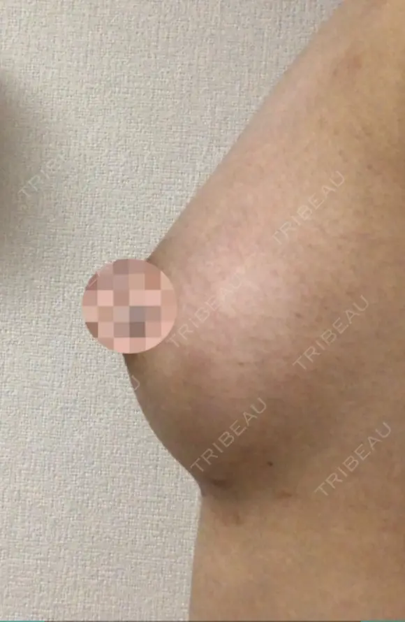 脂肪吸引（お腹） / 脂肪吸引（お尻） / 豊胸（脂肪注入） / その他（ボディ） ドクターフィット（Dr.fit）クリニック DAY 29 メイン用