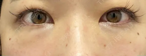 クマ治療 / 下まぶたの脂肪取り / 脂肪注入（肌） X CLINIC 大阪院 DAY 0 メイン用