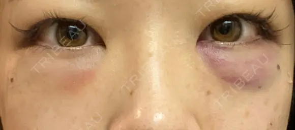 クマ治療 / 下まぶたの脂肪取り / 脂肪注入（肌） X CLINIC 大阪院 DAY 1 メイン用