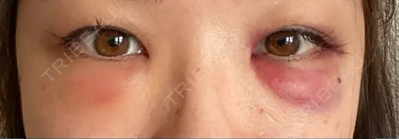 クマ治療 / 下まぶたの脂肪取り / 脂肪注入（肌） X CLINIC 大阪院 DAY 2 メイン用