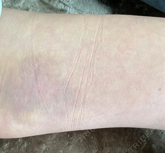 クマ治療 / 下まぶたの脂肪取り / 脂肪注入（肌） X CLINIC 大阪院 DAY 2 メイン用