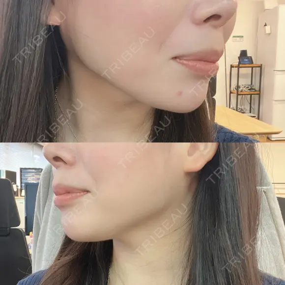 ヒアルロン酸注入（あご） 東京イセアクリニック DAY 1 メイン用