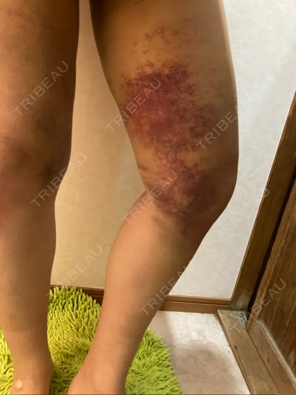 脂肪吸引（脚） 湘南美容クリニック 新潟院 DAY 6 メイン用