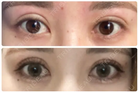 二重切開 / 上まぶたたるみ取り 城本クリニック 姫路院 AFTER メイン用