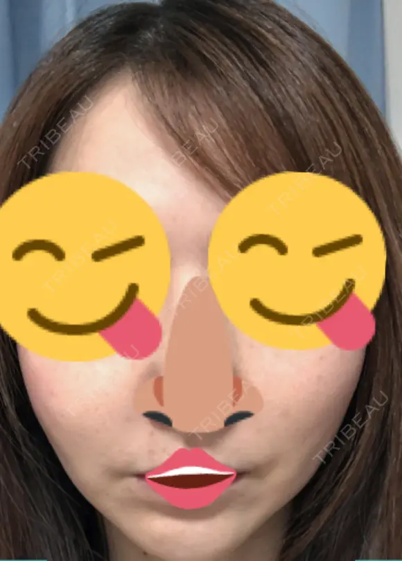 糸リフト / 水光注射（ハリ・美肌） / ヒアルロン酸注入（あご） / ハイフ（顔） 品川スキンクリニック表参道院 AFTER メイン用