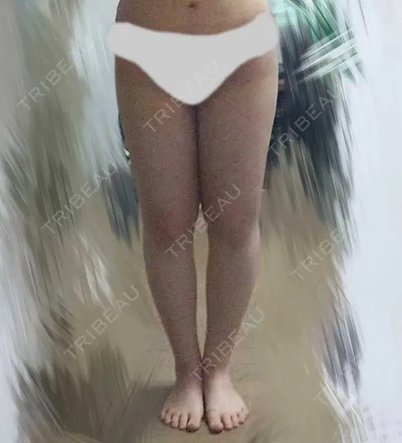脂肪吸引（脚） / インディバ（脚） 藤・ナチュレ美容クリニック 恵比寿院 DAY 28 メイン用