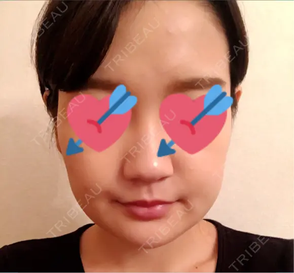 骨切り（あご） / 骨削り（エラ） / ルフォー+ssro（両あご) リラ・クラニオフェイシャル・クリニック DAY 24 メイン用