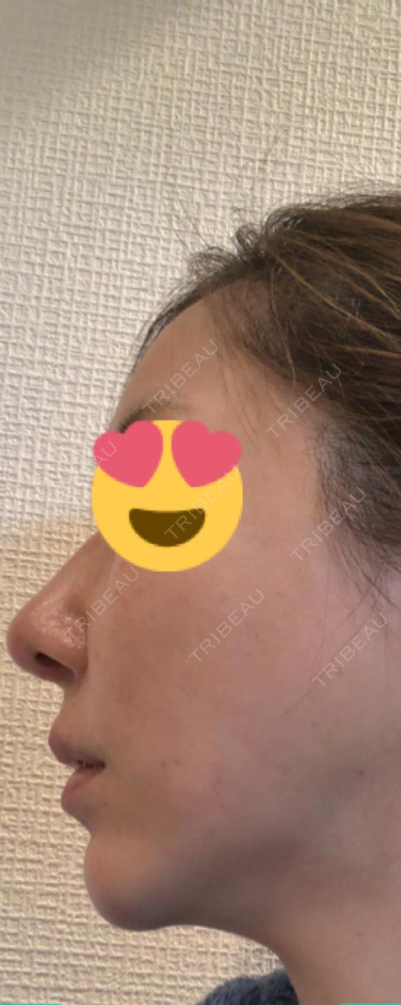 鼻中隔延長（切開） / 軟骨移植 / ワシ鼻修正・ハンプ切除 / ヒアルロン酸注入（鼻） プリモ麻布十番クリニック DAY 23 メイン用