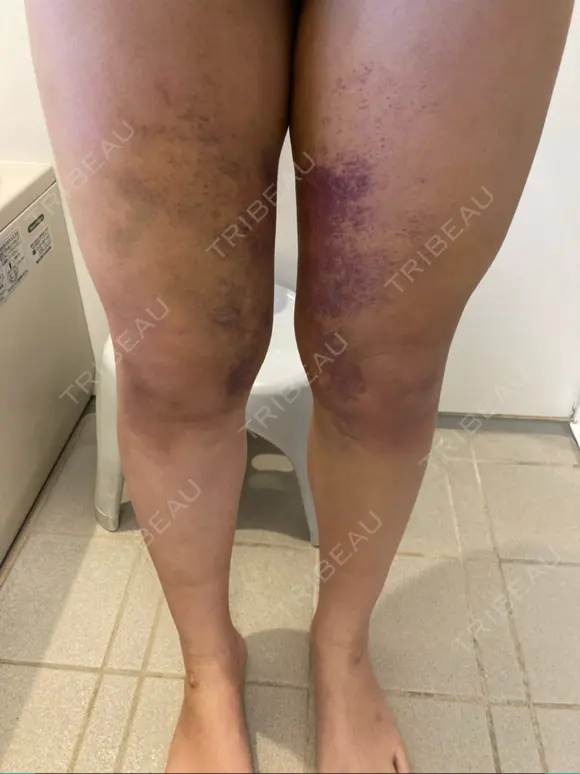 脂肪吸引（脚） 湘南美容クリニック 新潟院 AFTER メイン用