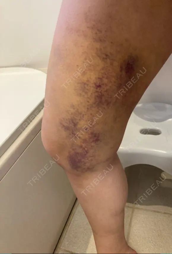 脂肪吸引（脚） 湘南美容クリニック 新潟院 DAY 8 メイン用