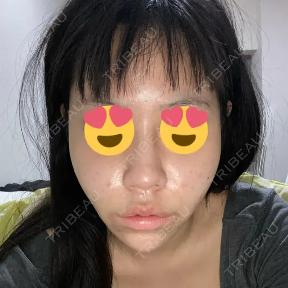 その他（鼻） ルラ美容クリニック 大宮院 / ルラスキンクリニック 大宮院 DAY 0 メイン用