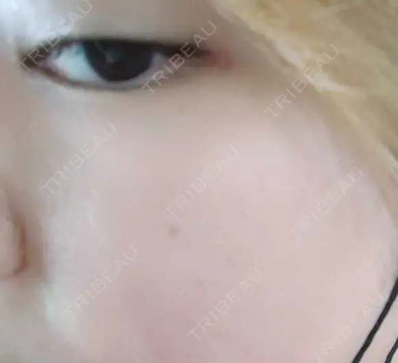 シミ取りレーザー PICO BEAUTY CLINIC DAY 2 メイン用