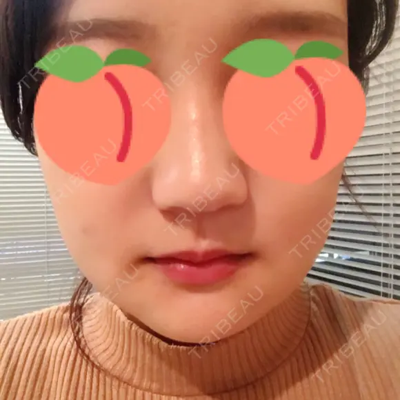 骨切り（あご） / 骨削り（エラ） / ルフォー+ssro（両あご) リラ・クラニオフェイシャル・クリニック DAY 16 メイン用