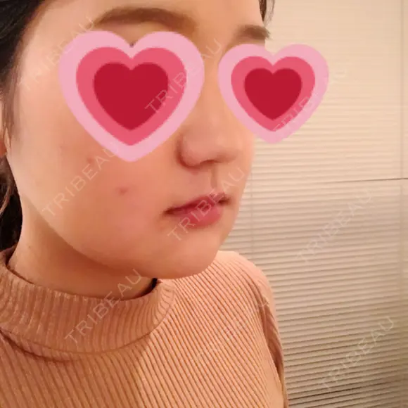 骨切り（あご） / 骨削り（エラ） / ルフォー+ssro（両あご) リラ・クラニオフェイシャル・クリニック DAY 16 メイン用