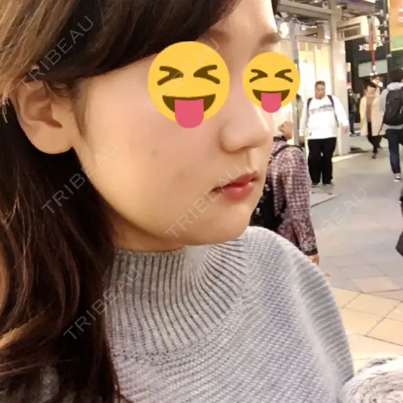 骨切り（あご） / 骨削り（エラ） / ルフォー+ssro（両あご) リラ・クラニオフェイシャル・クリニック DAY 11 メイン用