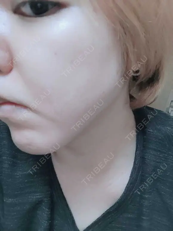 シミ取りレーザー PICO BEAUTY CLINIC DAY 5 メイン用