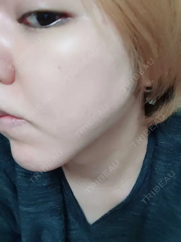 シミ取りレーザー PICO BEAUTY CLINIC DAY 6 メイン用