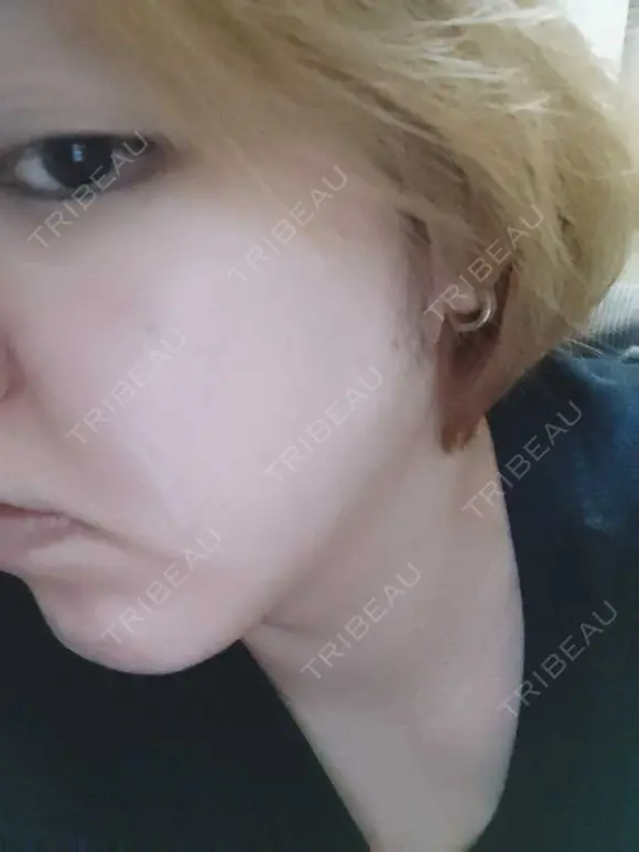 シミ取りレーザー PICO BEAUTY CLINIC DAY 7 メイン用