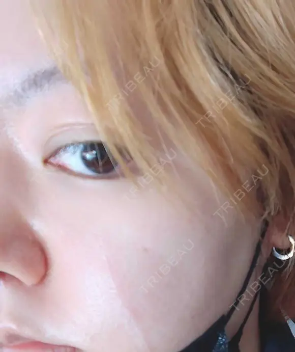 シミ取りレーザー PICO BEAUTY CLINIC DAY 8 メイン用