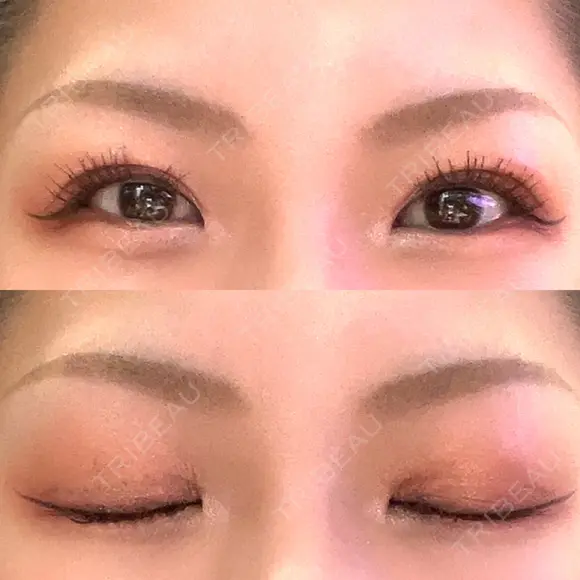 二重埋没 / 自然癒着法 シンデレラ＆ダヴィンチクリニック DAY 220 メイン用
