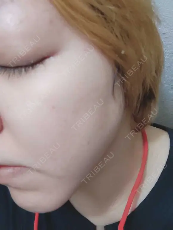 シミ取りレーザー PICO BEAUTY CLINIC AFTER メイン用