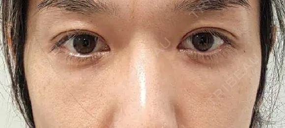 クマ治療 / 下まぶたたるみ取り / 下まぶたの脂肪取り セオリークリニック AFTER メイン用