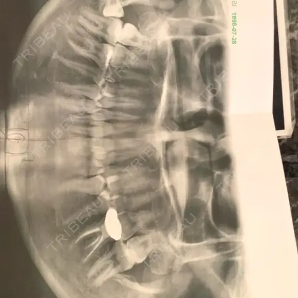 糸リフト / 骨切り（あご） / 脂肪吸引（顔） / ボトックス（エラ・小顔） 銀座マイアミ美容外科 AFTER メイン用