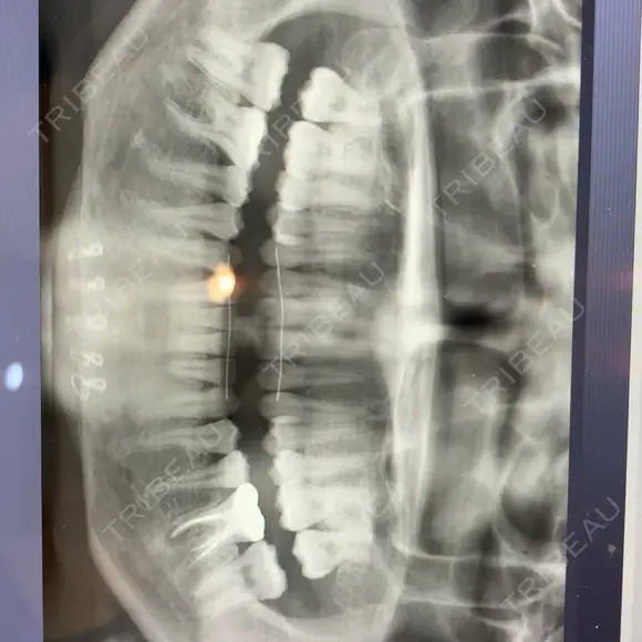 糸リフト / 骨切り（あご） / 脂肪吸引（顔） / ボトックス（エラ・小顔） 銀座マイアミ美容外科 DAY 275 メイン用