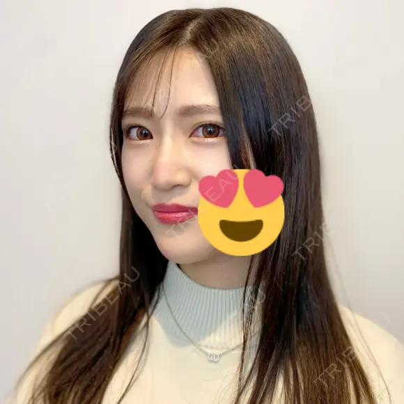 ヒアルロン酸注入（鼻） / ヒアルロン酸注入（あご） アクトリー勝どきウェルネスメディカルクリニック AFTER メイン用