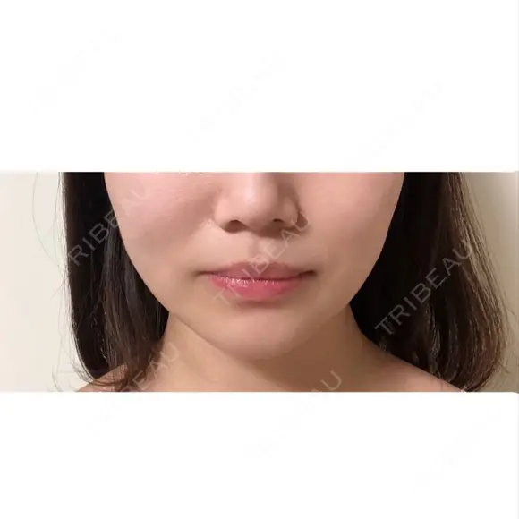 糸リフト / バッカルファット除去 / 脂肪吸引（顔） / 脂肪吸引（脚） / 脂肪吸引（お尻） / インディバ（お腹） 藤・ナチュレ美容クリニック 恵比寿院 DAY 14 メイン用