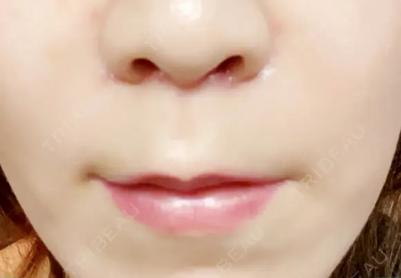人中短縮 / 鼻翼基部形成（貴族手術） / その他（口元） eクリニック 金沢本院 DAY 30 メイン用
