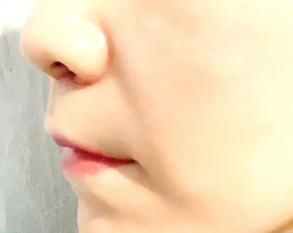 人中短縮 / 鼻翼基部形成（貴族手術） / その他（口元） eクリニック 金沢本院 DAY 30 メイン用
